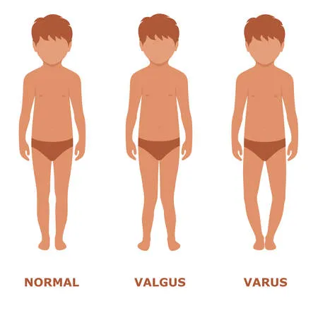 Schéma genou valgus et varus chez l'enfant